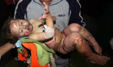 burned Palestinian toddler in Gaza: credit unavailable